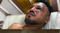 Schianto Air India, un sopravvissuto, era seduto all'11A: "Solo cadaveri intorno a me"
