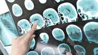 Alzheimer, i primi segnali possono comparire già 18 anni prima della perdita di memoria