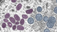 Mpox (vaiolo delle scimmie), Oms: "Resta emergenza sanitaria mondiale". Casi in aumento 
