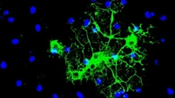 Sclerosi multipla, scoperto nuovo meccanismo di declino cerebrale
