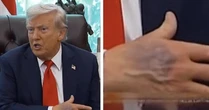 Bàn tay thâm tím của ông Trump gây chú ý