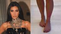 Kim Kardashian e la lotta alla psoriasi: sui social mostra l’eruzione cutanea sulla gamba