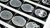 Lucas è il primo bambino al mondo a guarire da un cancro al cervello mortale: speranze per una cura