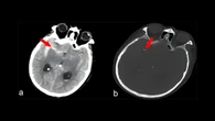 Va in ospedale in stato confusionale ma scopre di avere un ago per l’agopuntura nel cervello