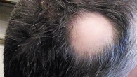 Caduta dei capelli, cos’è Litfulo (ritlecitinib), la pillola per la cura dell’alopecia areata grave