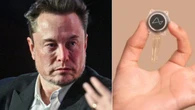 Cos’è il chip Neuralink di Elon Musk e come funziona il primo impianto nel cervello di un uomo