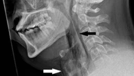 Chiude naso e bocca per trattenere uno starnuto ma finisce in ospedale con un buco nella gola