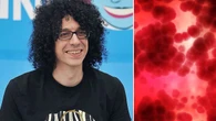 Giovanni Allevi e la malattia, cos’è il mieloma multiplo, quali sono i sintomi e come si cura il tumore