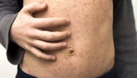 Perth Airport named measles exposure site
