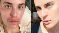 Tallulah Willis shows off dramatic ‘healing’ from skin picking disorder