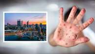 WA Health issues measles alert, lists exposure sites