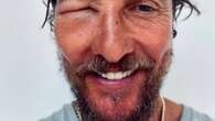 Matthew McConaughey’s face horrifically swollen by bee sting