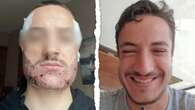 Man takes his own life following botched hair transplant