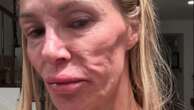 Brandi Glanville hasn't had sex in more than a year due to facial disfigurement