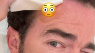 Kevin Jonas has skin cancer removed