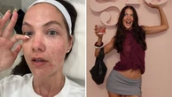 Perth influencer documents PAINFUL salmon sperm facial