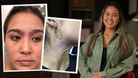 ‘Pure hell’: Eczema sufferer’s battle with steroid cream