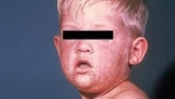 Fresh warning as dangerous virus spreads