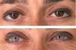 Changement de couleur des yeux à visée esthétique : ne pas méconnaître les risques de la kératopigmentation