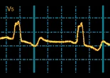 AI finds hidden ECG signal that predicts sudden cardiac death risk