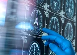 Effect of antiamyloid Alzheimer’s drugs ‘absent or trivial,’ Cochrane review finds