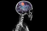 Tumors Hijack the Nervous System to Fuel Their Own Growth