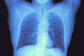 Removing Race from Lung Function Tests Could Benefit Millions of Black Americans