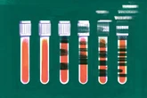 New Alzheimer’s Blood Tests Promise Early Detection but No Clear Path Forward