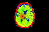 1 in 4 Unresponsive People with Brain Injuries May Be Conscious