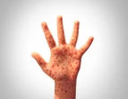 Do ‘Alternative’ Measles Treatments Touted by RFK Jr. Work?