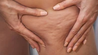 Tak pozbędziesz się cellulitu. "Body combing" wygładzi i ujędrni skórę. Wystarczy 10 minut dziennie