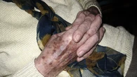 Seniorki robiÄ mieszankÄ z 10 kropli i trzymajÄ na dĹoniach 15 minut. Chodzi o plamy starcze
