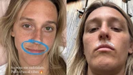 Aleksandra Żebrowska ma problemy skórne. "Pogarszają się od słońca i wyglądają jak wąsy"