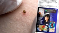 Ukąsił ją kleszcz. "Dwa tygodnie koszmaru", ale nie przez boreliozę. "Wymiotowanie z bólu"