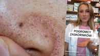 Czarne kropki "pod ostrzałem". Farmaceutka poleca 3 pogromców zaskórników