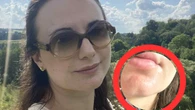 Nie zmarszczki i nie oparzenia. To pojawiĹo siÄ na mojej skĂłrze po tygodniu bez SPF