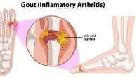 Gejala Asam Urat Tinggi yang Perlu Diwaspadai, Bisa Timbulkan Masalah Kesehatan