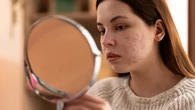 Skin Purging: Efek Skincare Baru yang Sering Dikira Breakout atau Jerawat