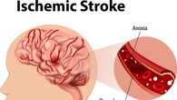 Mengenal Stroke Iskemik, Penyebab Hingga Penanganannya