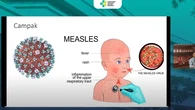 Wabah Campak di Sumenep, Mengenal Virus Penyebabnya yang Sangat Menular