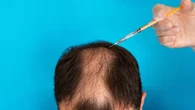 Hasil Transplantasi Rambut Mengecewakan, Klinik Disuruh Ganti Rugi Pelanggan Rp110 Jutaan