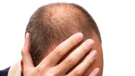 Bahan-Bahan Alami yang Cocok untuk Menebalkan Rambut, Gunakan untuk Mencegah Kebotakan