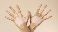 Cara Baru Atasi Bercak Vitiligo, Teknologi Fototerapi Bantu Tingkatkan Rasa Percaya Diri P...