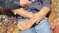 Kisah Pilu Pria Sukabumi dengan Kutil Seluruh Tubuh, Puluhan Tahun Tak Dapat Pengobatan