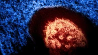 Measles may be circulating in small northeast B.C. community, says health authority