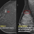 Advocates want more cancer screening for those in N.S. with dense breasts