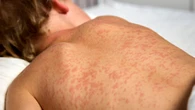 Measles outbreak: Ontario sees over 220 new cases in a week