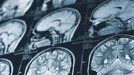 N.B. delays report on mystery brain illness, sends all data for federal review