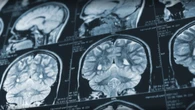 Patient advocate calls for retraction of mystery brain disease report from U.S. medical journal
