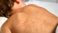 Measles outbreak expected to continue in northeast B.C. with 5 or more new cases a day, health officials say